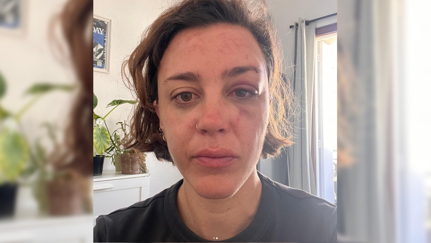 , Agression lesbophobe &agrave; Montpellier : Laura d&eacute;nonce l&rsquo;attaque de &laquo;&nbsp;quatre ou cinq hommes&nbsp;&raquo; et l&rsquo;inaction de la police