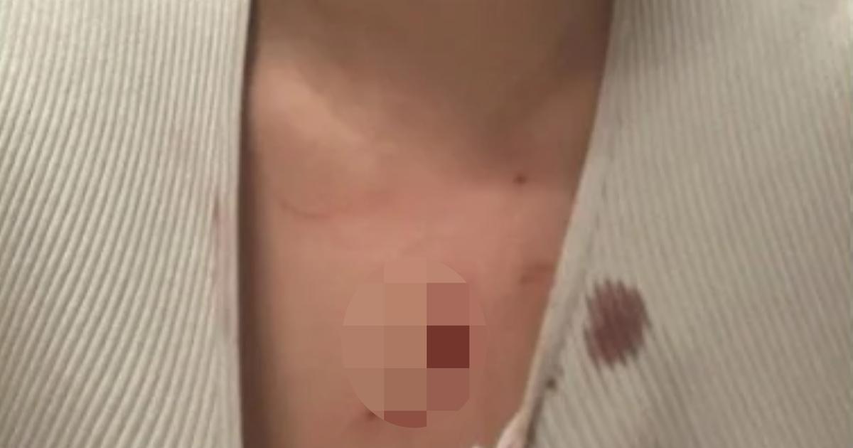 , Lyon : apr&egrave;s l&rsquo;agression de sa fille, elle lance une p&eacute;tition pour demander l&rsquo;installation de la vid&eacute;osurveillance